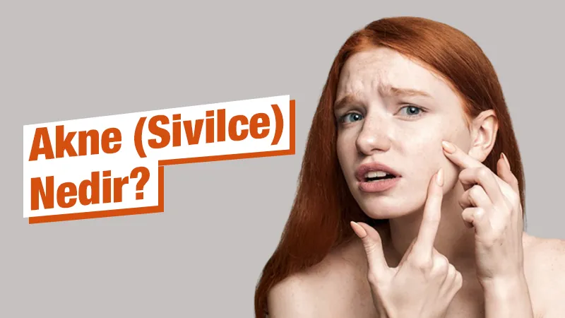 Akne (Sivilce) Nedir? Nasıl geçer?