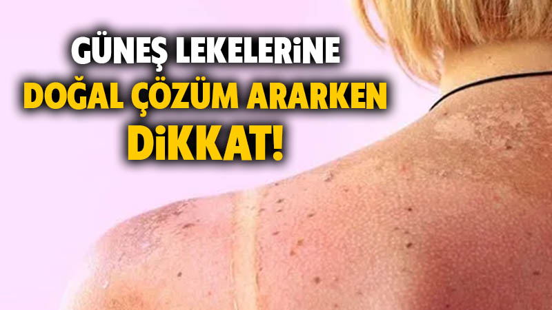 Güneş lekelerine doğal çözüm ararken nelere dikkat edilmeli?