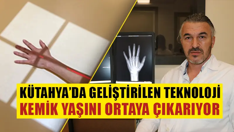 Kütahya’da geliştirilen teknoloji ile kemik yaşı ve cinsiyet tespit ediliyor