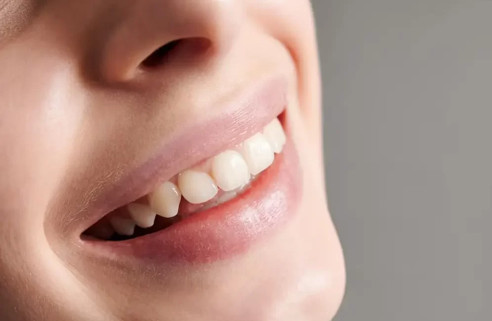 Overbite Nedir? Overbite, üst